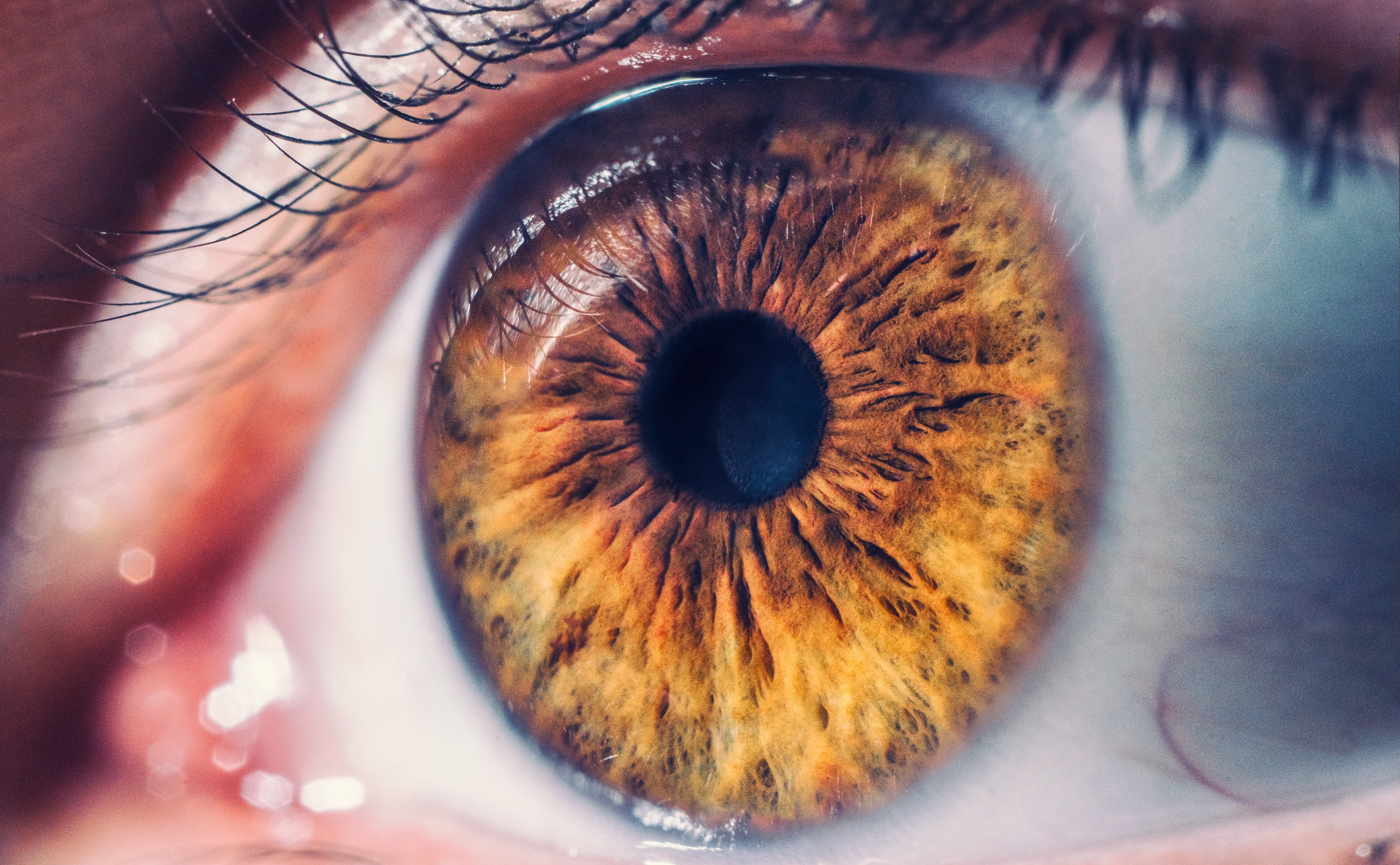 Глаз л. Пигментный ретинит сетчатки.
