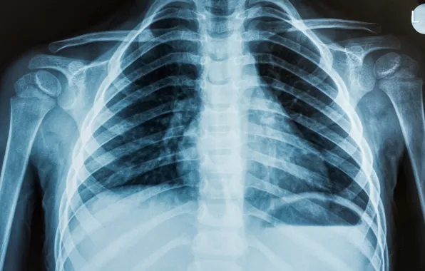 Man, chest, ribs, x-ray