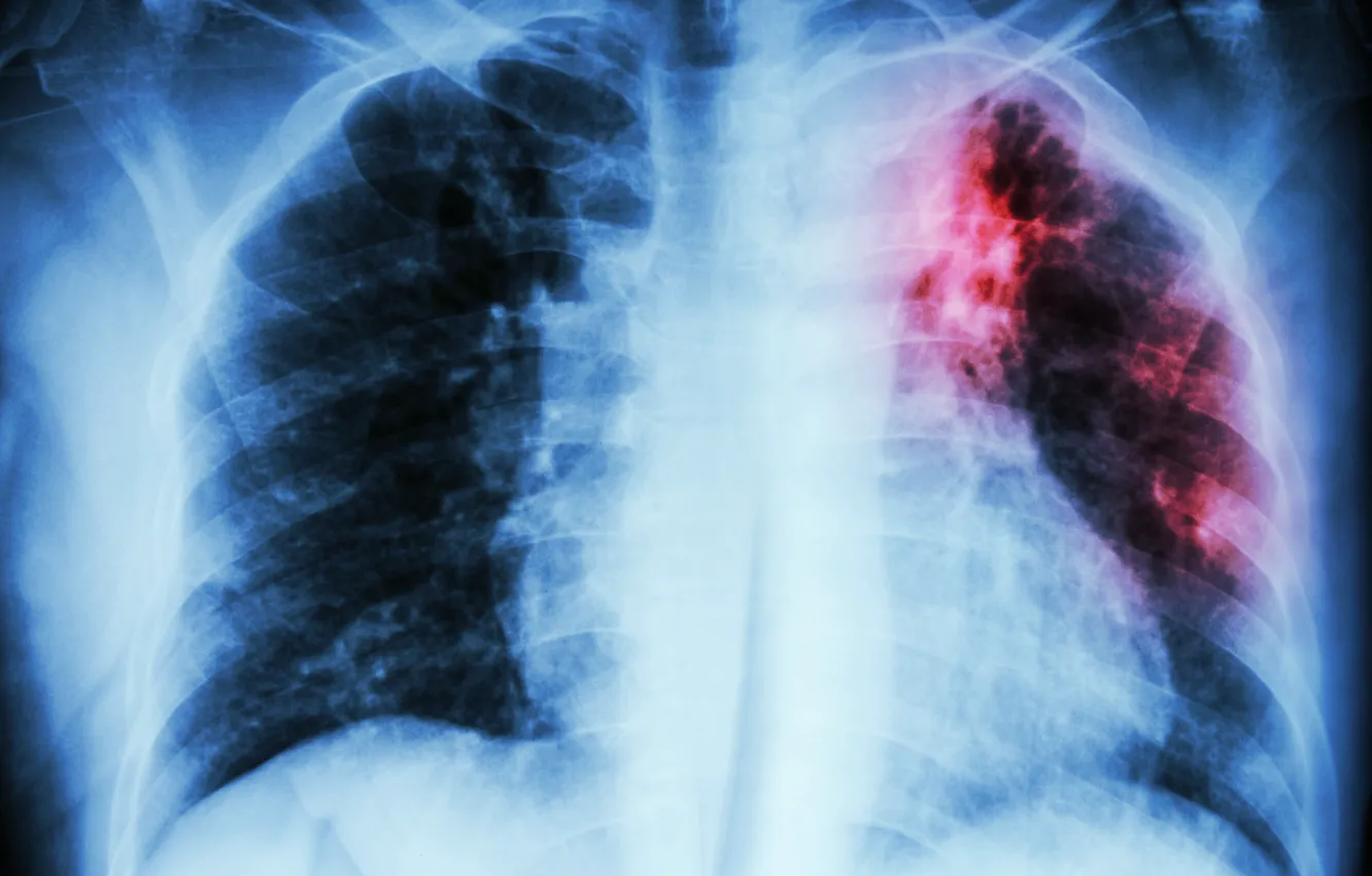 Фото обои stain, disease, lungs, radiography, infection