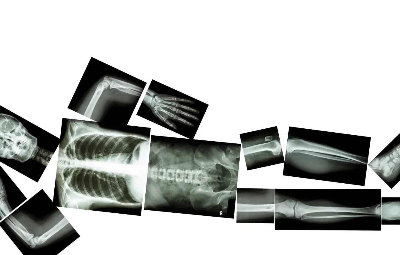 Фото обои pose, bone plates, X-rays