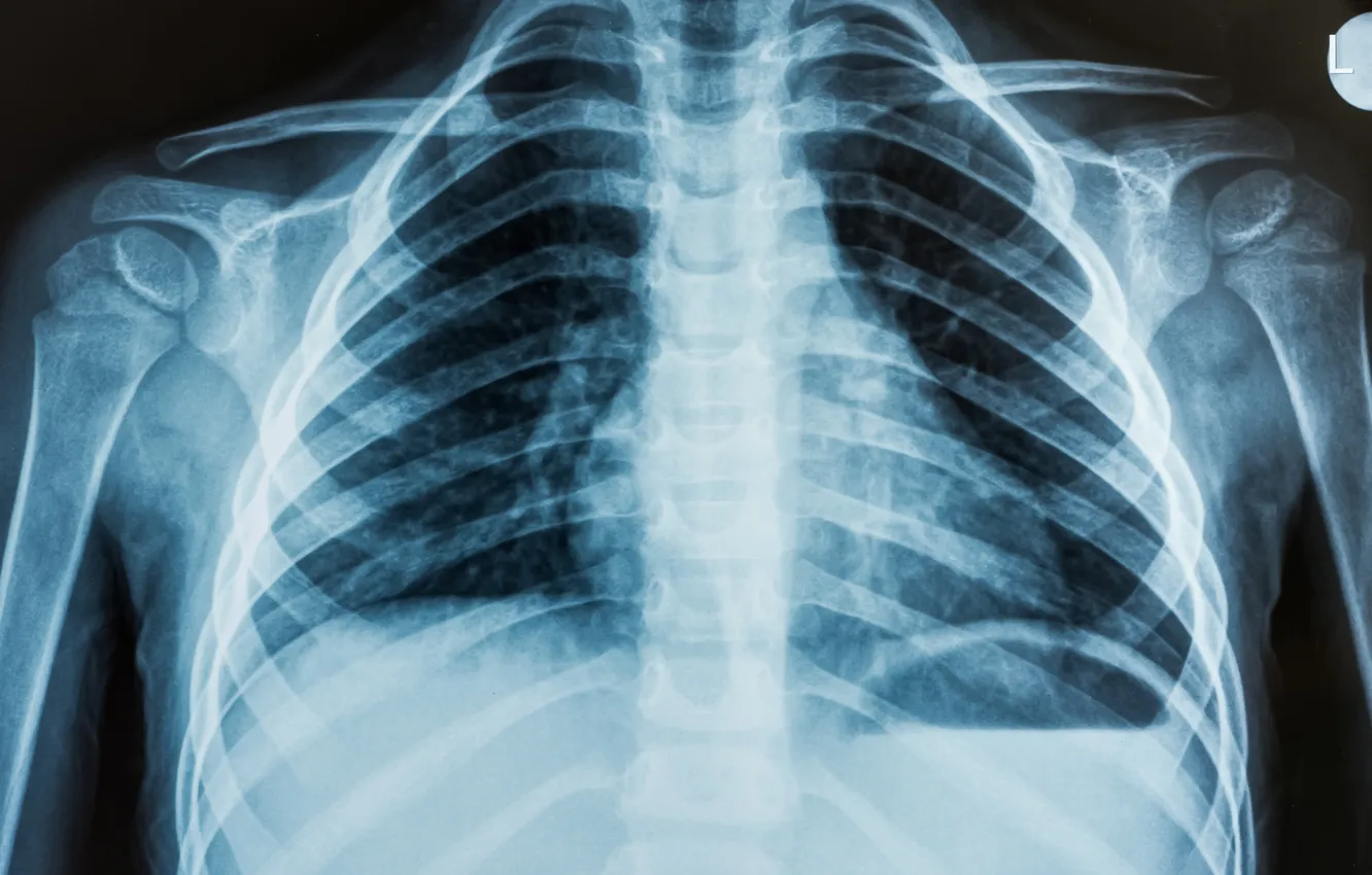Фото обои man, chest, ribs, x-ray